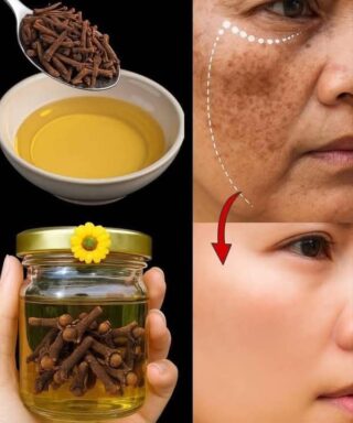 Natural Clove Garlic Skin Remedy for Dark Spots and Wrinkles