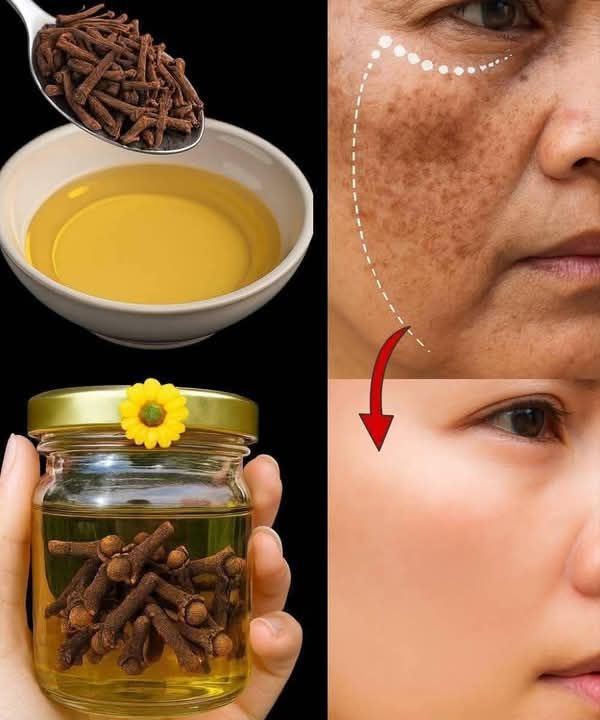 Natural Clove Garlic Skin Remedy for Dark Spots and Wrinkles